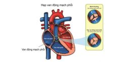 Hẹp van động mạch phổi: Triệu chứng và cách điều trị