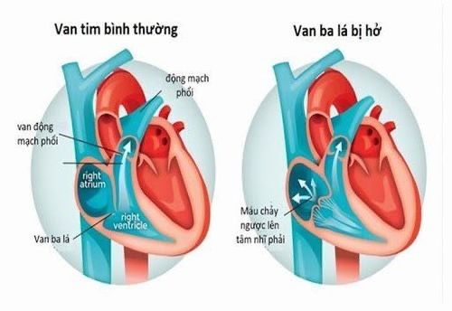 Các giai đoạn của hở van ba lá