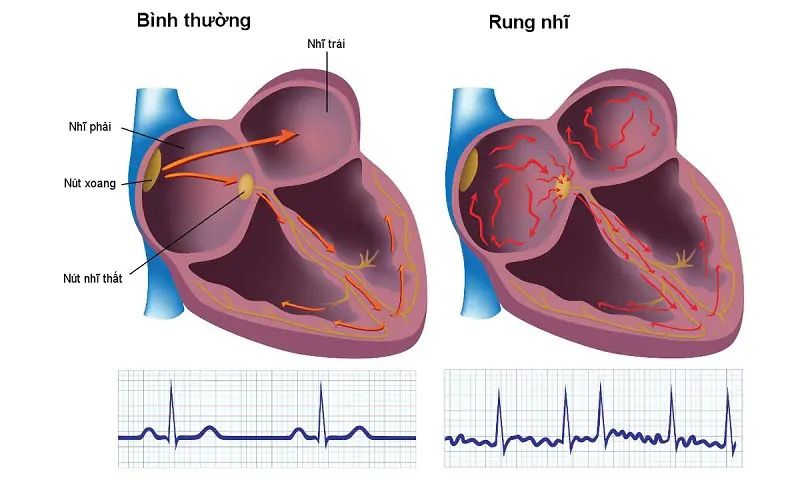 Tất cả những điều cần biết về rung nhĩ