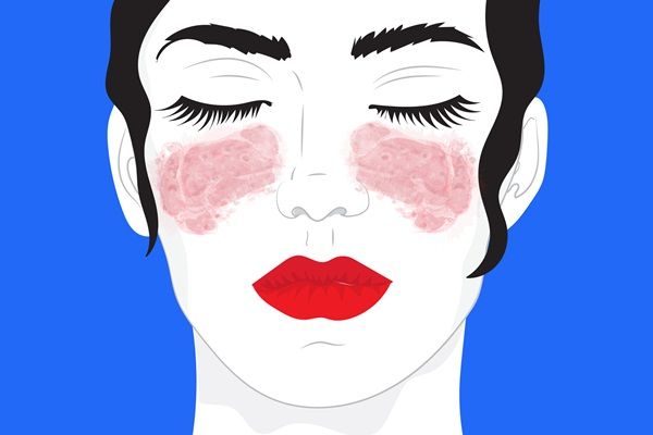 Stress ảnh hưởng như thế nào đến bệnh lupus ban đỏ?