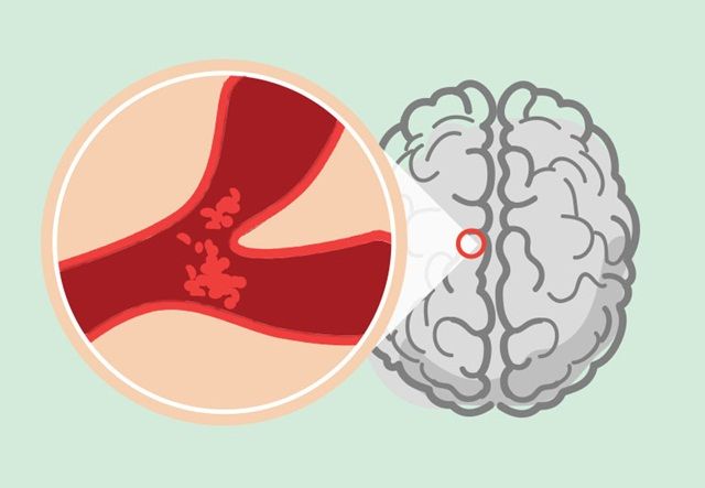 Giảm nguy cơ đột quỵ sau cơn thiếu máu não thoáng qua