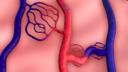 Dị dạng động tĩnh mạch điều trị bằng cách nào?