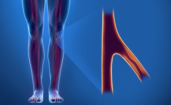 Các phương pháp điều trị bệnh động mạch ngoại biên