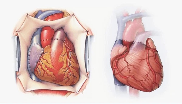 Những điều cần biết về bệnh tim bẩm sinh ở người lớn