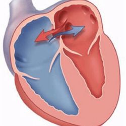 Những điều cần biết về dị tật vách ngăn nhĩ thất