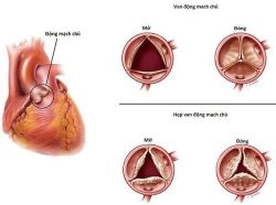 Những điều cần biết về dị tật kênh nhĩ thất