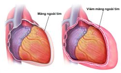 Viêm màng ngoài tim: Nguyên nhân, triệu chứng và cách điều trị