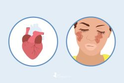 Viêm màng ngoài tim do lupus điều trị bằng cách nào?