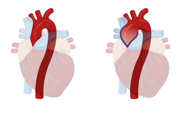 Phân biệt lóc tách động mạch chủ và phình động mạch chủ