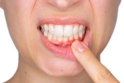 Bệnh nướu răng có làm tăng nguy cơ mắc bệnh tim không?