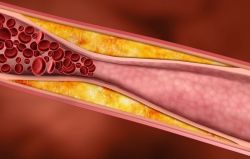 Triglyceride ảnh hưởng đến sức khỏe như thế nào?