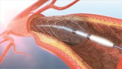 Stent có thể tồn tại bao lâu?
