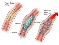 Những điều cần biết về hồi phục sau khi đặt stent tim