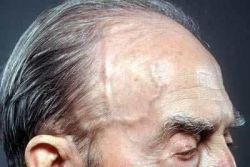 Có phương pháp nào chữa khỏi viêm động mạch tế bào khổng lồ không?