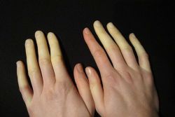 Mối liên hệ giữa viêm khớp vảy nến và hội chứng Raynaud là gì?