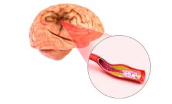 Cách ngăn ngừa phình động mạch não là gì?