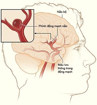 Người bị phình động mạch não tập tạ có an toàn không?