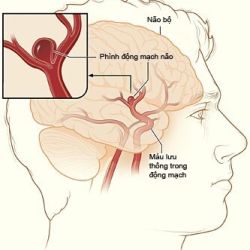 Người bị phình động mạch não tập tạ có an toàn không?