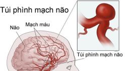 Phình động mạch não khi mang thai có nguy hiểm không?