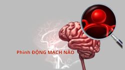Chụp cắt lớp vi tính (CT scan) có giúp phát hiện được phình động mạch não không?
