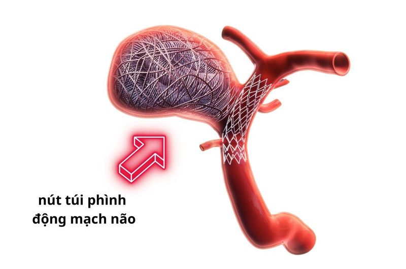 Tìm hiểu về phương pháp can thiệp nút phình động mạch não