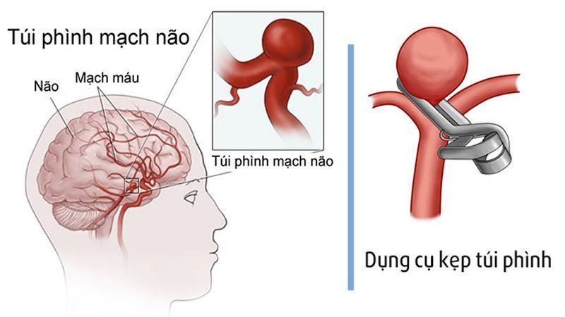 Những điều cần biết về phẫu thuật kẹp túi phình động mạch não