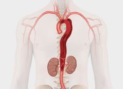 Lóc tách động mạch chủ: Nguyên nhân, triệu chứng và điều trị