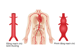 Những điều cần biết về phình động mạch chủ bụng dưới thận