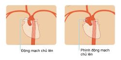 Phình động mạch chủ lên có tiên lượng ra sao?