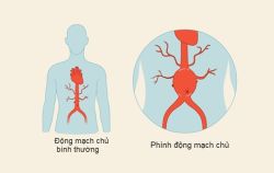 Phình động mạch chủ bụng: Triệu chứng và phương pháp điều trị