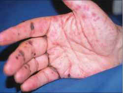 Viêm mạch hủy bạch cầu là gì?