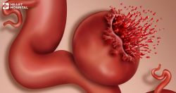 Dấu hiệu và điều trị vỡ túi phình động mạch chủ