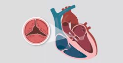 Hẹp van động mạch chủ ảnh hưởng đến huyết áp như thế nào?