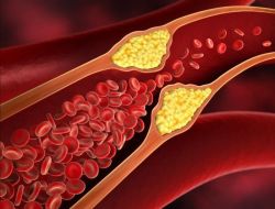 Vì sao có mức triglyceride cao nhưng mức cholesterol lại bình thường?