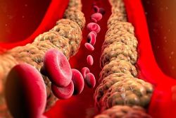 Tìm hiểu về lipoprotein tỷ trọng thấp (LDL) – Loại cholesterol xấu