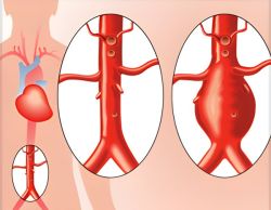 Huyết khối động mạch chủ: Triệu chứng, phương pháp điều trị và biến chứng