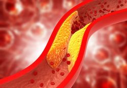 Cholesterol cao có di truyền không?