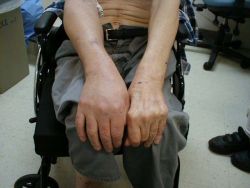 Huyết khối tĩnh mạch sâu chi trên: Triệu chứng và phương pháp điều trị