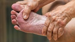 Huyết khối tĩnh mạch gan bàn chân điều trị bằng cách nào?