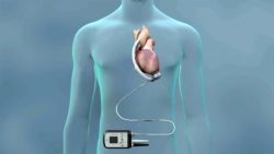 Thiết bị hỗ trợ tâm thất trái (LVAD): Công dụng và rủi ro