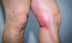 Viêm tĩnh mạch huyết khối: Nguyên nhân, triệu chứng và cách điều trị