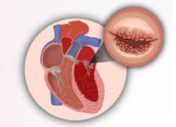 Sự khác biệt giữa bệnh thấp tim và sốt thấp khớp