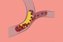 Tăng lipid máu hỗn hợp có tính gia đình là gì?