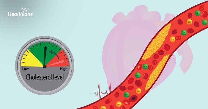 Mức cholesterol khuyến nghị theo độ tuổi