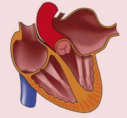 Phì đại nhĩ trái: Triệu chứng và cách điều trị