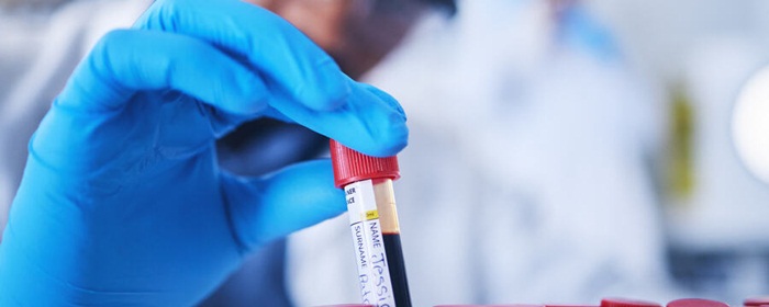 Tăng cholesterol máu có tính gia đình đồng hợp tử là gì?