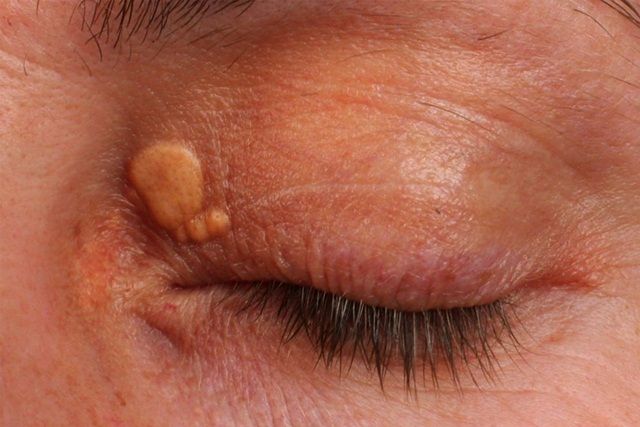 U vàng quanh mắt: Nguyên nhân và cách điều trị