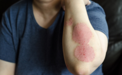 Hội chứng Churg – Strauss là gì?