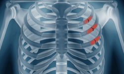 Gãy xương sườn: Dấu hiệu và phương pháp điều trị