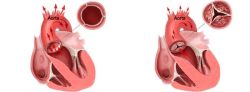 Hẹp van động mạch chủ ảnh hưởng đến huyết áp như thế nào?